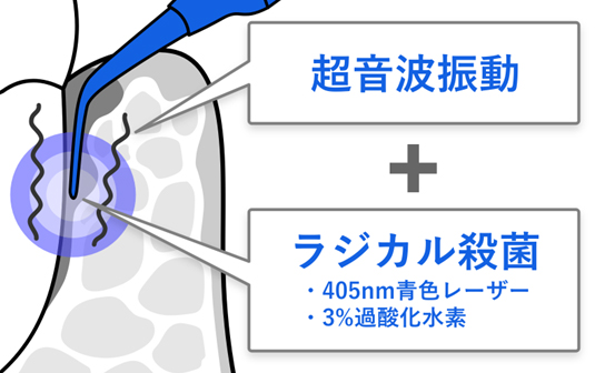 歯周病治療の必要性