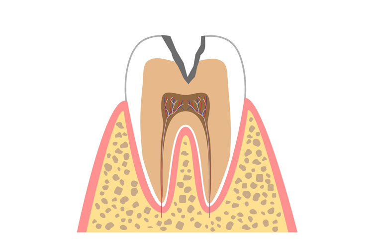 C2(象牙質う蝕)