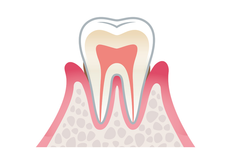最初は歯肉炎という状態