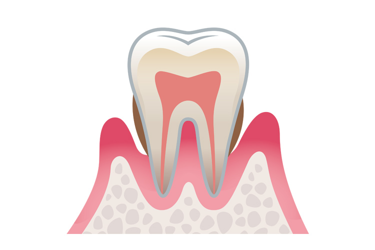歯肉炎から歯周炎へ
